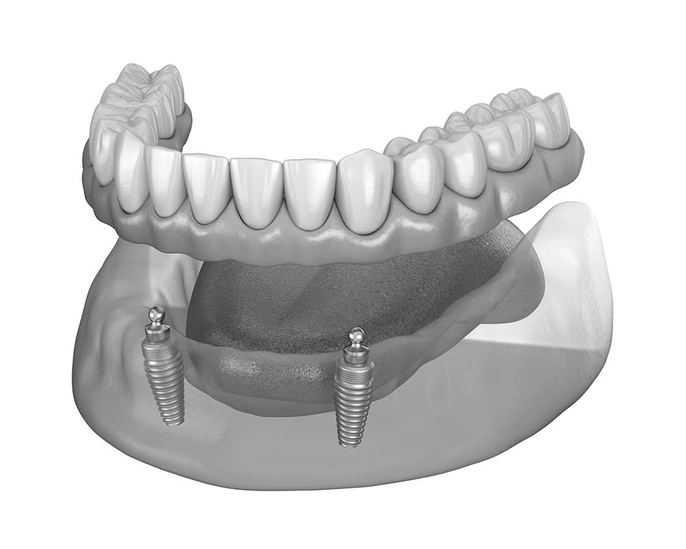 Implants dentaires