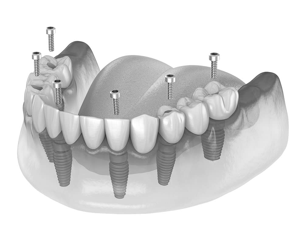 Implants dentaires